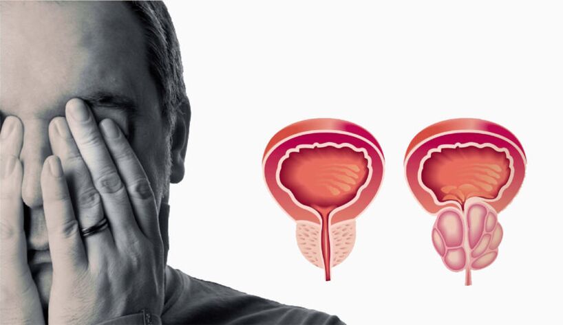 Chronesch Prostatitis