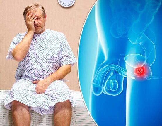 Symptomer vun Prostatitis