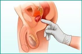 Palpatioun vum Prostata