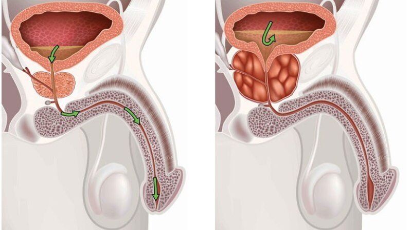 gesond an entzündegt Prostata Drüs mat Prostatitis