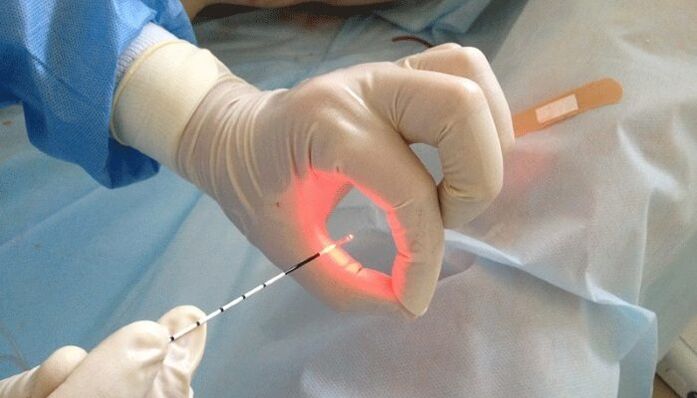 Laser Behandlung fir Prostatitis
