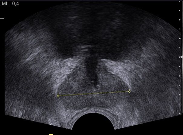 gesond Prostata op Ultraschall nom Predstonorm huelen